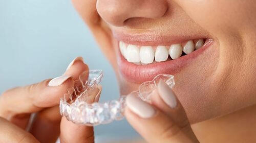 Clear Aligners