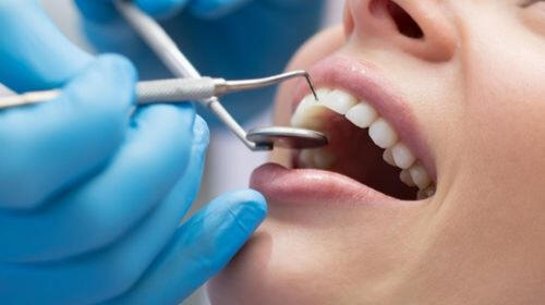 Dental Fillings