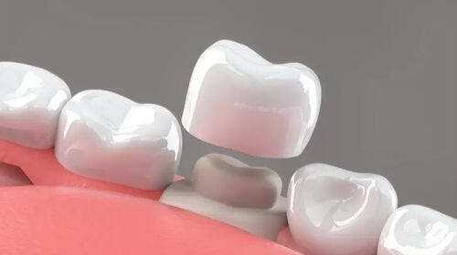 Dental Crowns
