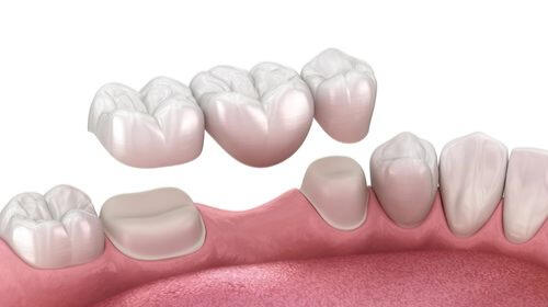 Dental Bridges