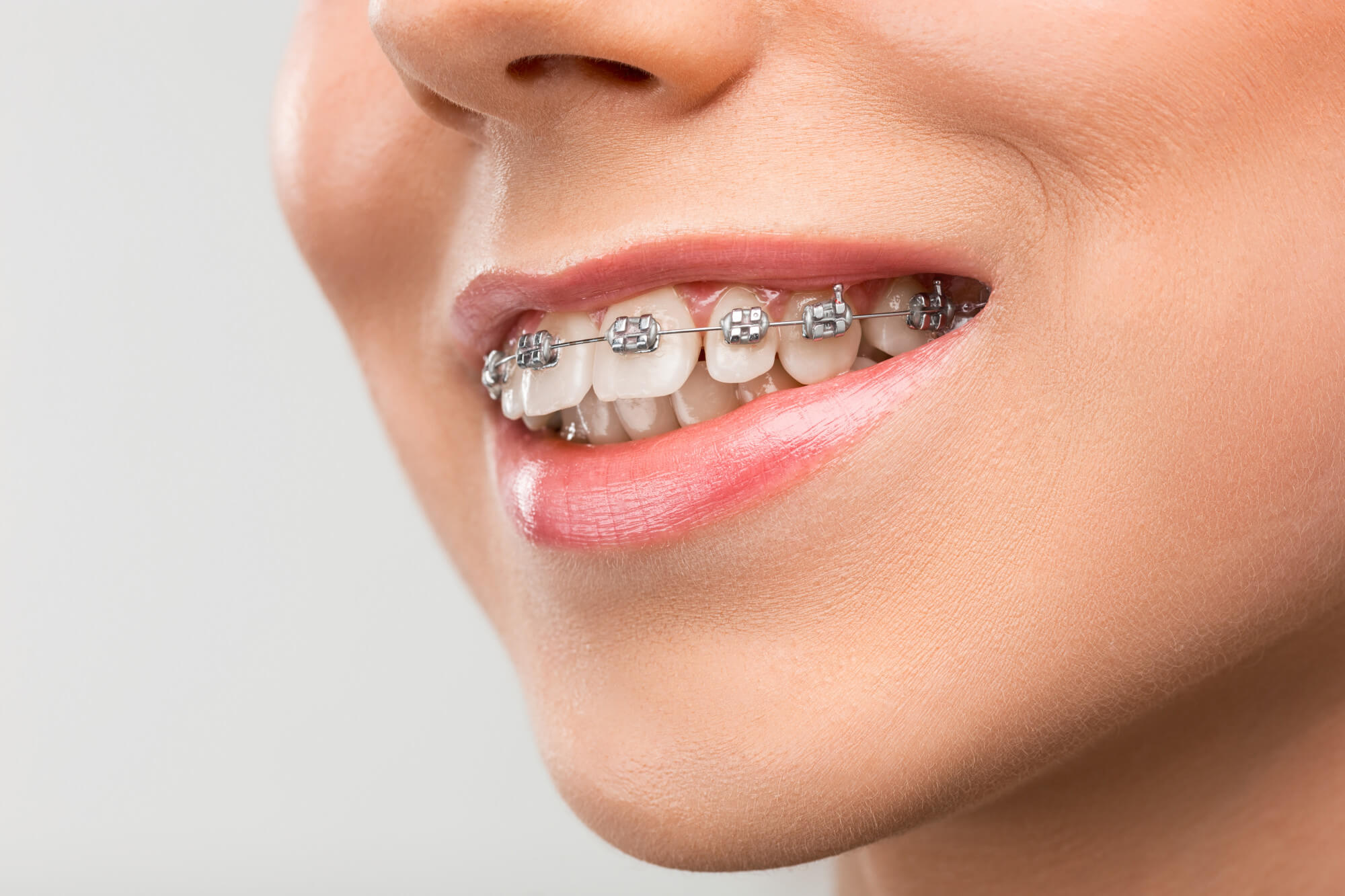 Orthodontic Treatment at happy dental care clinics negombo