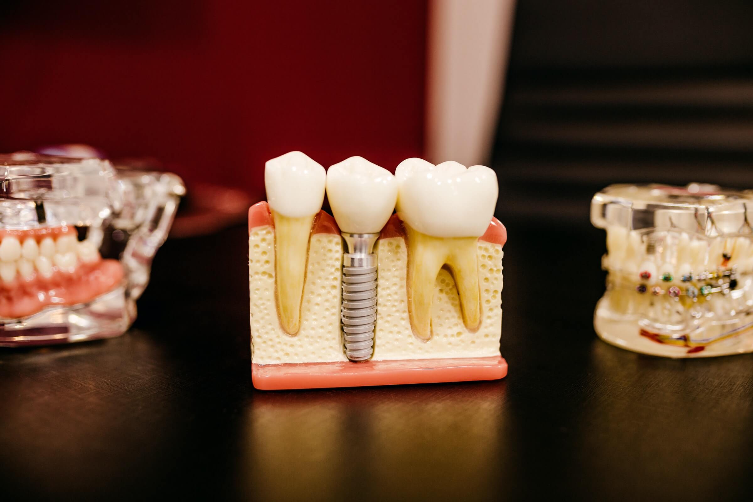 dental implant at happy dental care negombo
